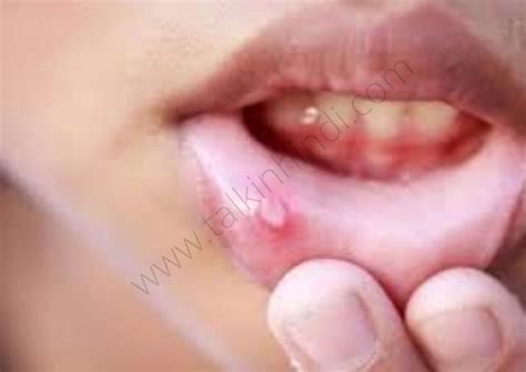 muh  chale kaise thik kare home remedies  hindi talkinhindi