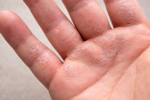 Itchy Palms: 7 Weird Causes You've Never Heard About (But Should ...