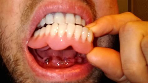 12+ Full Mouth Extraction Immediate Dentures Pictures - HuzaifahPavel