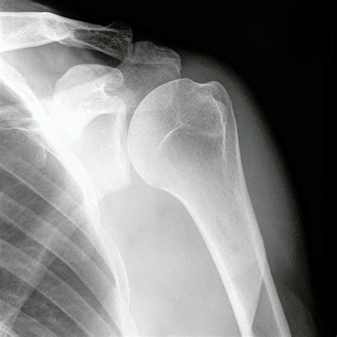 NORMAL SHOULDER 7 - Buyxraysonline