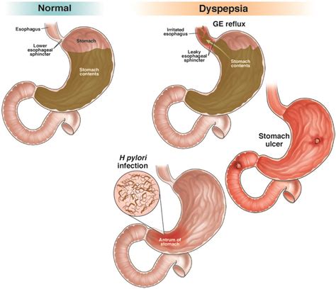 dyspepsia aga gi patient center