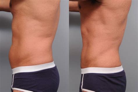smartlipo liposuction   york city lipo