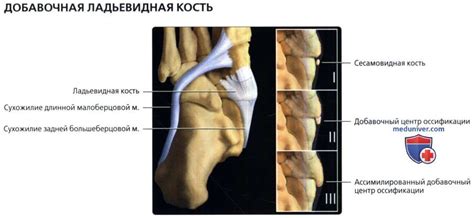 Добавочная ладьевидная кость на рентгенограмме, МРТ