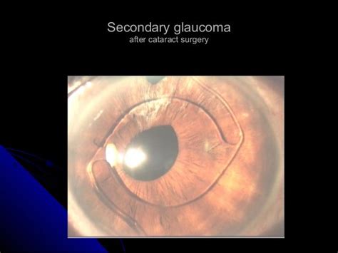 Secondary glaucoma