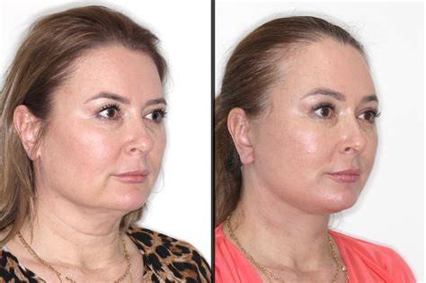 IN VOGUE: The Deep Plane Facelift IN VOGUE: The Deep Plane Facelift ...