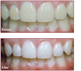 teeth whitening dentist