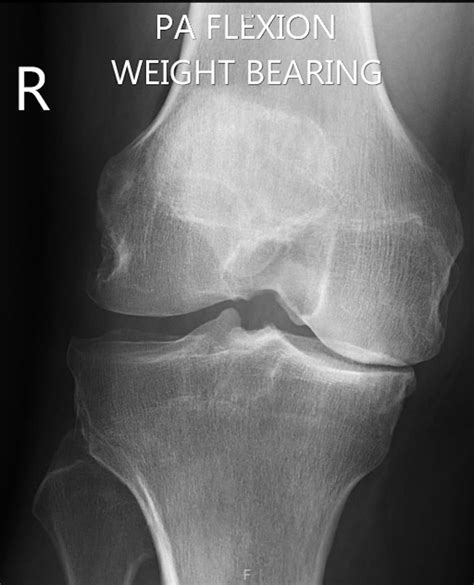 High tibial osteotomy in combination with arthroscopic abrasion