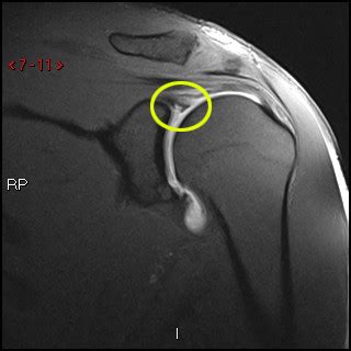 posterior labral tear shoulder mri