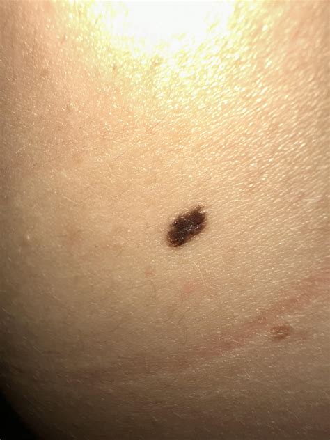 What do you guys think? Melanoma? I’m thinking of getting biopsy but it