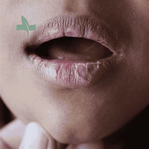Chapped Lips: Causes, Symptoms and Treatments — SageMED