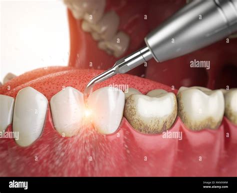 Professional teeth cleaning. Ultrasonic teeth cleaning machine delete ...