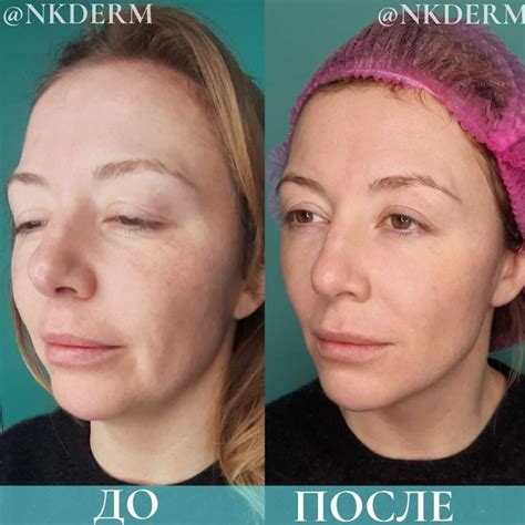 NKDERM | Смас-лифтинг
