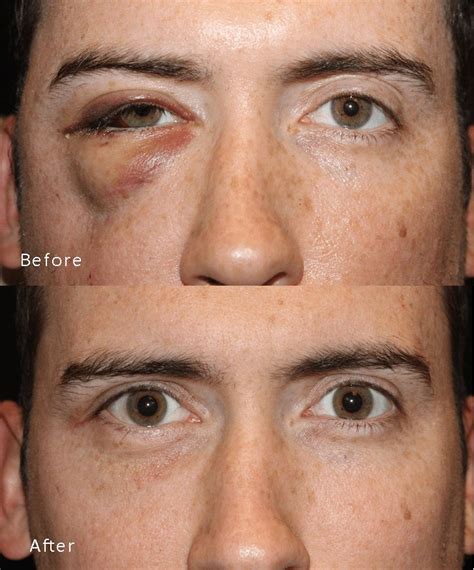 Trauma Repair/Reconstruction gallery » Dallas Ophthalmology Surgeons | Texas Ophthalmic Plastic ...