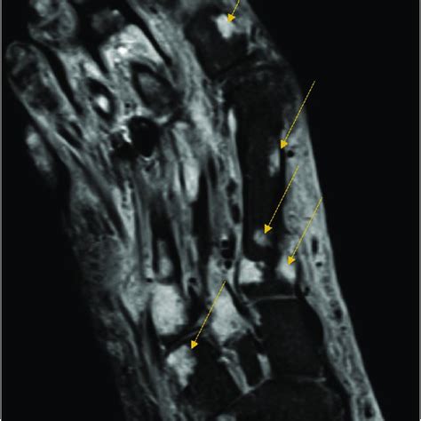 MRI of the right foot -shows diffuse soft tissue swelling with mild ...