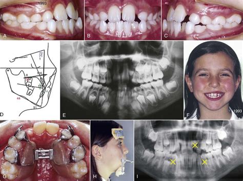 missing maxillary lateral incisors pocket dentistry