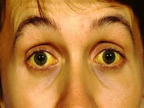 Fatty Liver: 10 Fatty Liver Symptoms