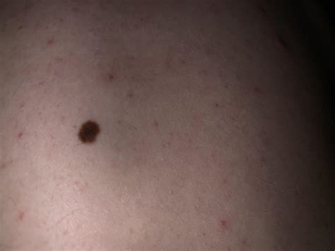 Is this melanoma? : r/Melanoma