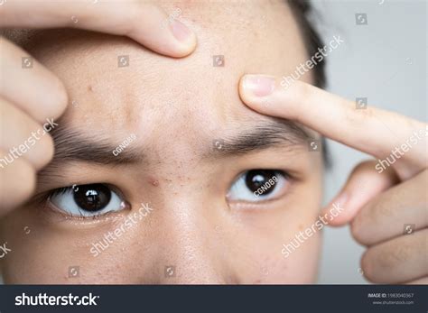 3 Large Sebum Plug Images, Stock Photos, 3D objects, & Vectors ...