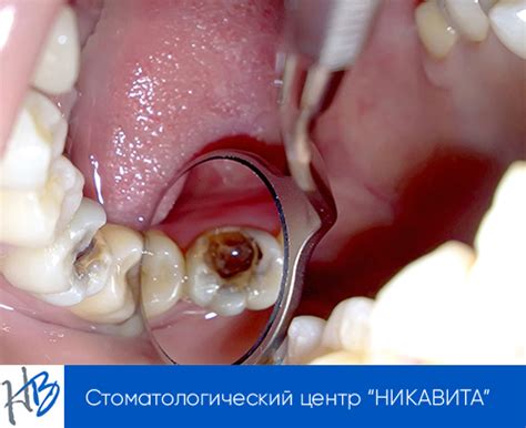Лечение пульпита зуба в Минске