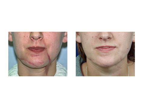 scar-revision-face-dr-barry-eppley-indianapolis - Explore Plastic Surgery