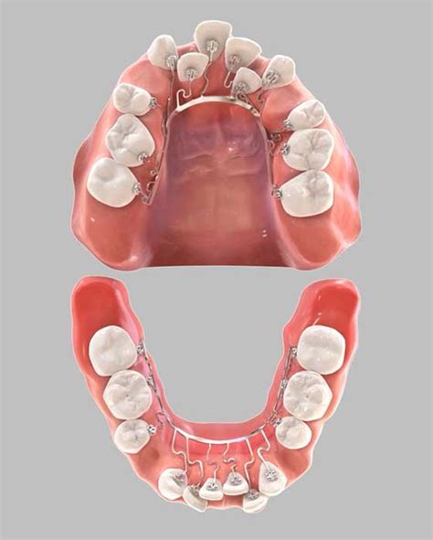 จัดฟันด้านใน Brius มองไม่เห็นว่าจัดฟัน | คลินิกทันตกรรมไลค์ Like Dental ...