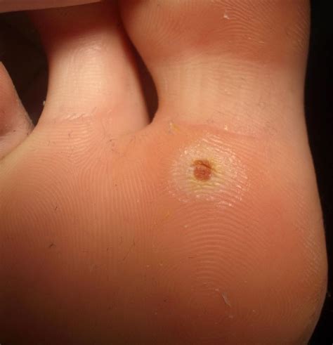 Olho De Peixe No Dedo Da Mão - Olho De Peixe Na Mão Fotos - RETOEDU