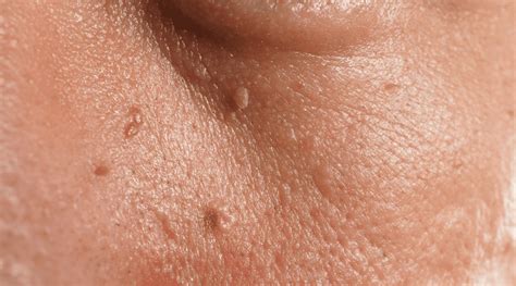 Skin Tags Groin