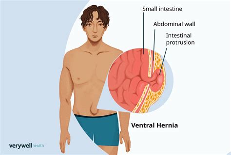 understanding ventral hernia
