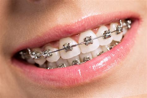 background  braces  interesting blog