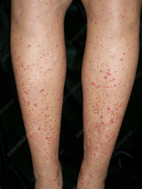 henoch schonlein purpura stock image  science photo library