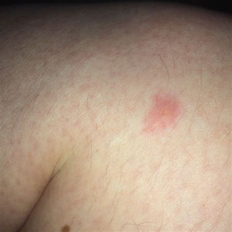 Zeckenbiss: Ist die Rötung normal? (Gesundheit und Medizin, Arzt, Haut)