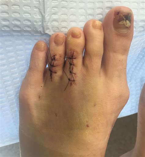 Toe Shortening and Toe Lengthening Surgery – New Cosmetic Foot Surgery