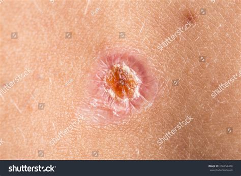 scar  wound  alma jones blog