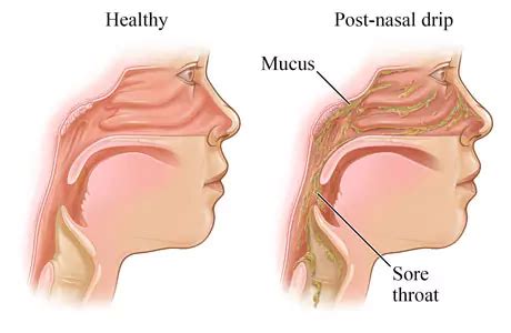 Why It Feels Like Mucus Stuck in Throat - CoughPro™