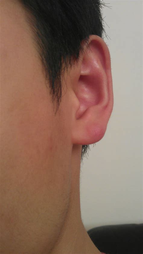 Big lump on earlobe (with pics) : r/AskReddit