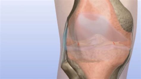 Kneecap Surgery