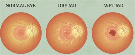 What you need to know about Wet AMD - Envision Ophthalmology & Wellness