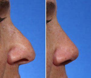 hook nose meaning jewish hooked nose hook nose rhinoplasty