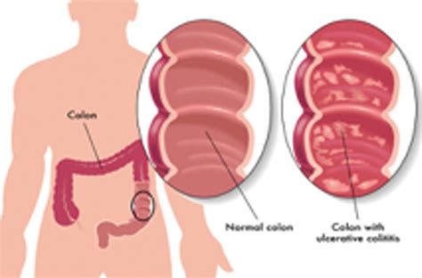 Mucous Colitis