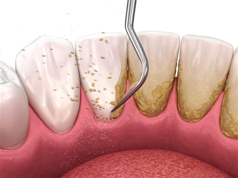 scaling  root planing  gum disease periodontal therapy
