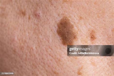 19 Seborrheic Keratoses Stock Photos, High-Res Pictures, and Images ...