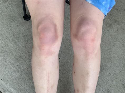 How long til the bruising goes away/when to be concerned. : r/Dermatology