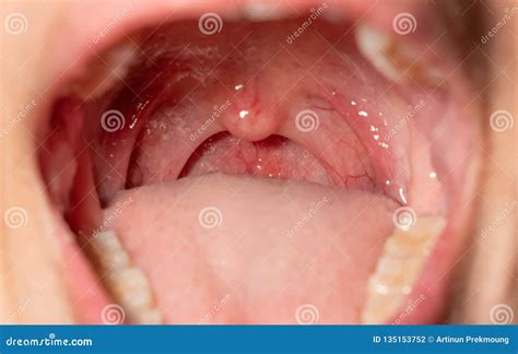 Sore Throat With Throat Swollen. Closeup Open Mouth With Posterior Pharyngeal Wall Swelling And ...