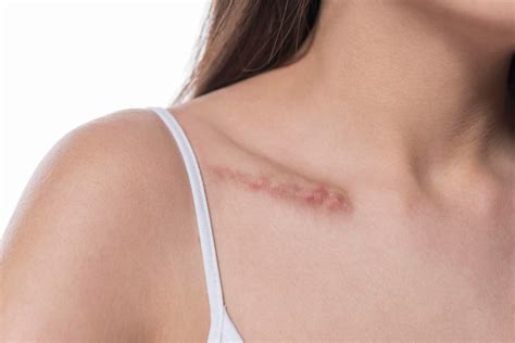 Hypertrophic Scar : Treatment ,Causes, Tips and Prevention