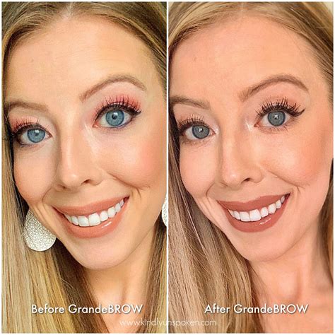 Unbelievable Blackhead Removal 2024: My Honest Review & Before/After Pics. Image 9