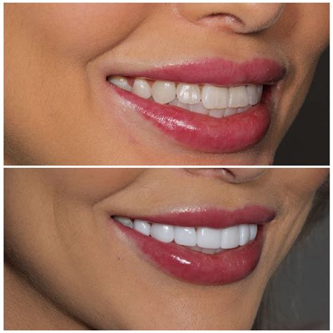 veneers porcelain composite veneers
