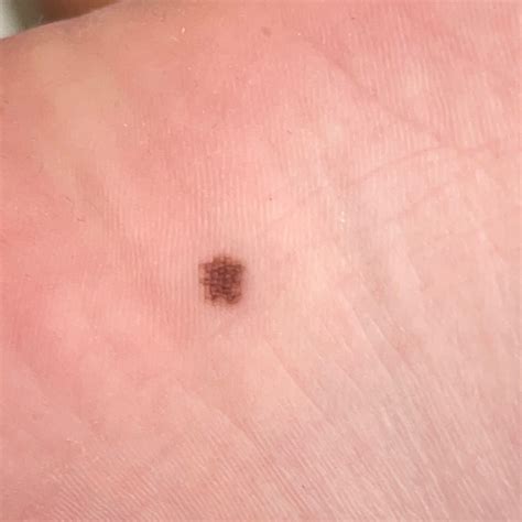 Acral Nevus (ICD-10: D22) - Online consultation AI dermatologist