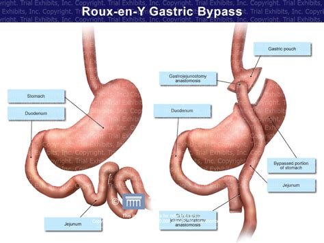 Roux En Y Gastric Bypass Anatomy