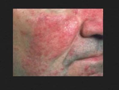 Rashes Treatment Service in Kolkata, Mukundapur by Aashwas Chest ...