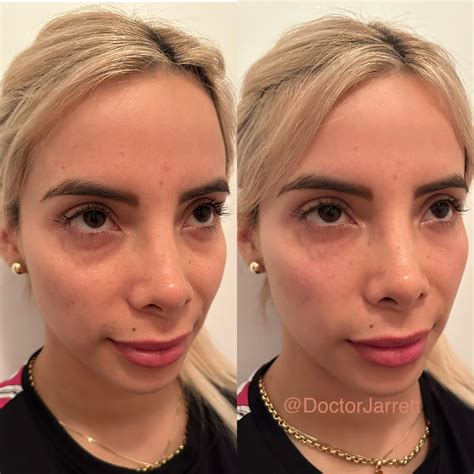 UnderEye Filler - Designer Aesthetics by Dr. Jarrett Schanzer | Miami